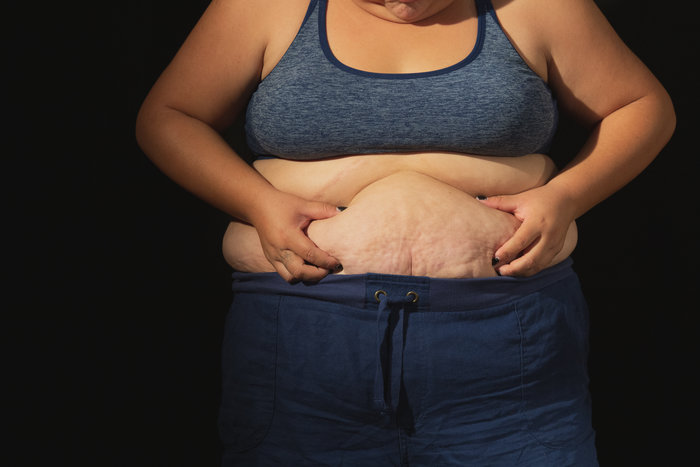 An obese woman holding belly fat in her hands 